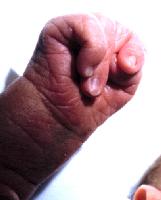 Edwards Syndrome Clenched Hands