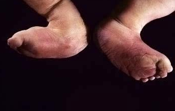 Edwards Syndrome Trisomy 18